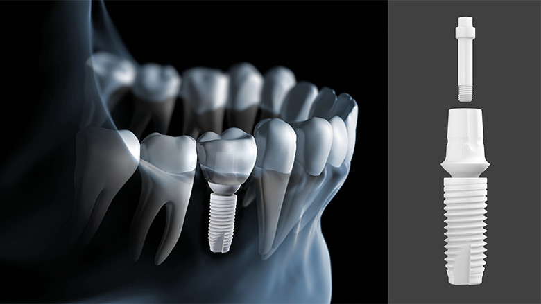 Straumann Dental Implants supplied by Straumann